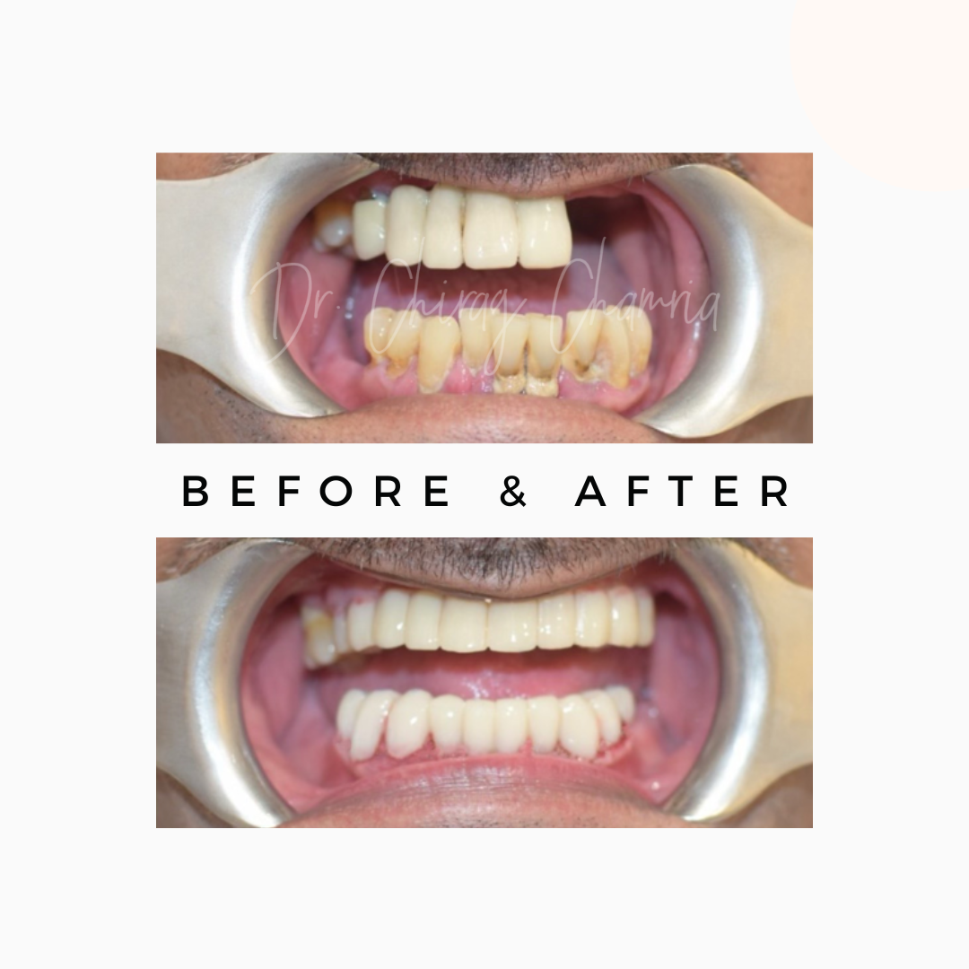 Full Mouth Dental Treatment